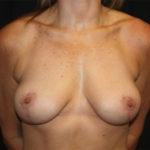 Breast Lift Before & After Patient #27256