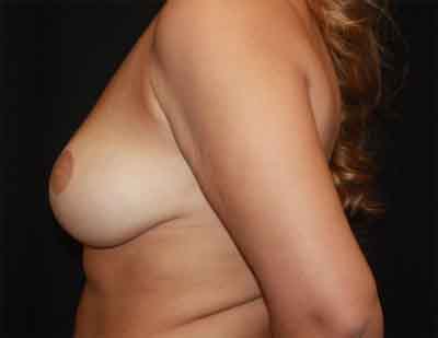 Breast Reduction Before & After Patient #27100