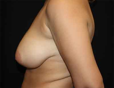 Breast Reduction Before & After Patient #27100