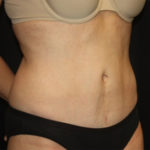 Tummy Tuck Before & After Patient #27133