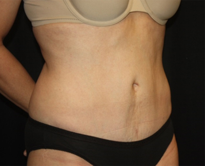 Tummy Tuck Before & After Patient #27133