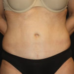 Tummy Tuck Before & After Patient #27133