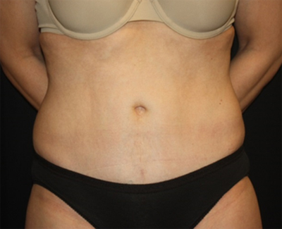 Tummy Tuck Before & After Patient #27133