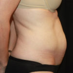 Tummy Tuck Before & After Patient #27133