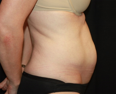 Tummy Tuck Before & After Patient #27133