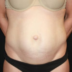 Tummy Tuck Before & After Patient #27133