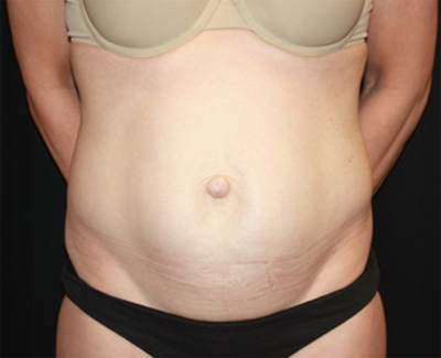 Tummy Tuck Before & After Patient #27133