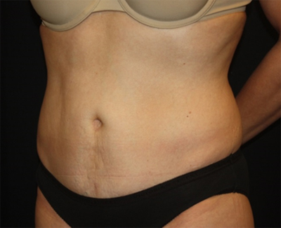 Tummy Tuck Before & After Patient #27133