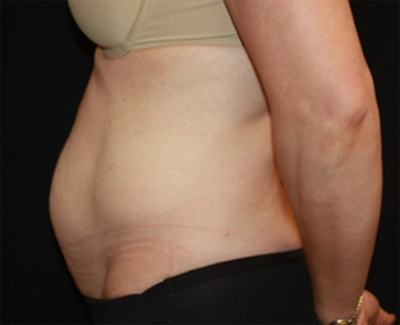 Tummy Tuck Before & After Patient #27133