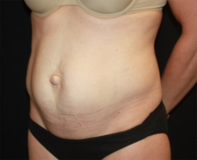 Tummy Tuck Before & After Patient #27133