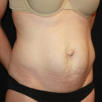 Tummy Tuck Before & After Patient #27133