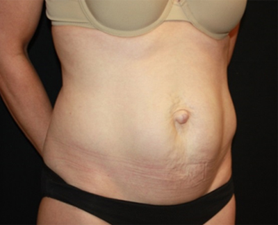 Tummy Tuck Before & After Patient #27133