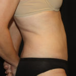 Tummy Tuck Before & After Patient #27133