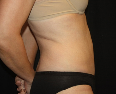 Tummy Tuck Before & After Patient #27133