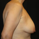 Breast Lift Before & After Patient #27199