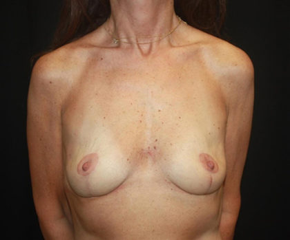 Breast Lift Before & After Patient #27199