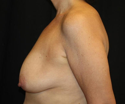 Breast Lift Before & After Patient #27199