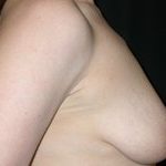 Breast Lift Before & After Patient #27272