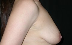 Breast Lift Before & After Patient #27272