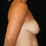 Breast Lift Before & After Patient #27277