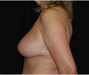 Breast Lift Before & After Patient #27299