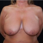 Breast Lift Before & After Patient #27299