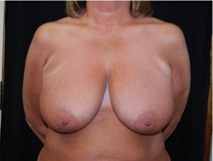 Breast Lift Before & After Patient #27299