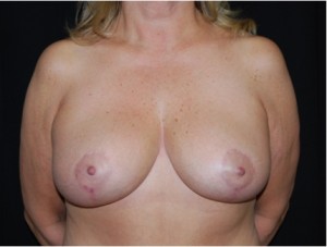 Breast Lift Before & After Patient #27299