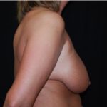 Breast Lift Before & After Patient #27299