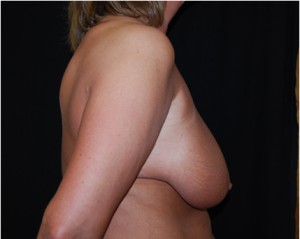 Breast Lift Before & After Patient #27299