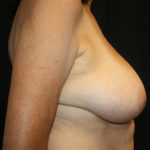 Breast Lift Before & After Patient #27359