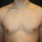 Gynecomastia Before & After Patient #27185