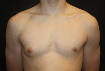 Gynecomastia Before & After Patient #27185