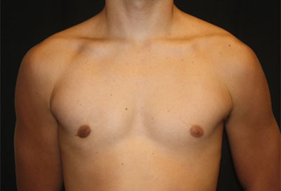 Gynecomastia Before & After Patient #27185