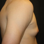 Gynecomastia Before & After Patient #27185