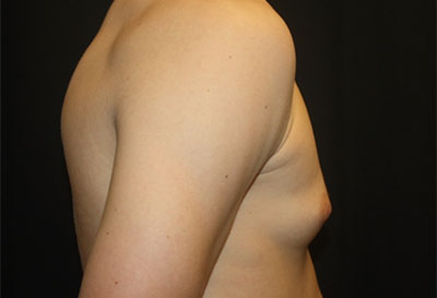 Gynecomastia Before & After Patient #27185