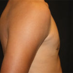 Gynecomastia Before & After Patient #27185