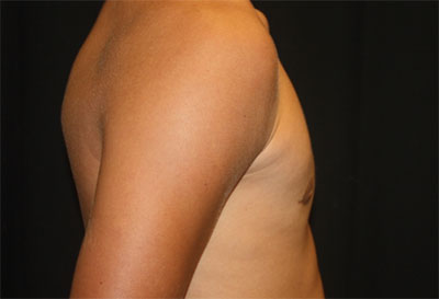 Gynecomastia Before & After Patient #27185