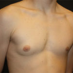 Gynecomastia Before & After Patient #27185