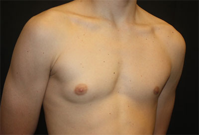 Gynecomastia Before & After Patient #27185