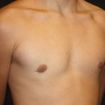 Gynecomastia Before & After Patient #27185