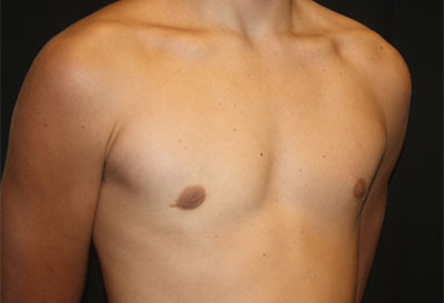 Gynecomastia Before & After Patient #27185