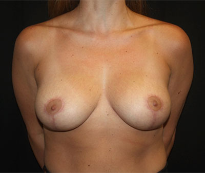Breast Lift Before & After Patient #27192