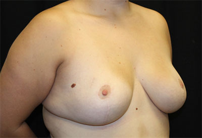 Breast Reduction Before & After Patient #27111