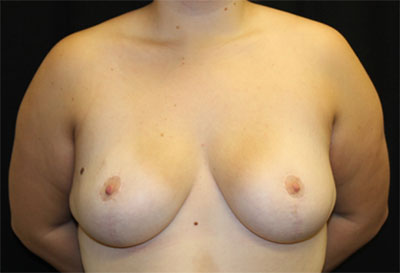 Breast Reduction Before & After Patient #27111