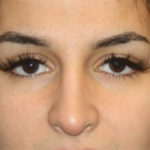 Rhinoplasty Before & After Patient #27163