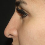 Rhinoplasty Before & After Patient #27163