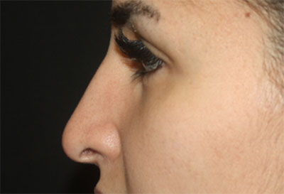 Rhinoplasty Before & After Patient #27163