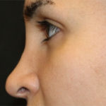 Rhinoplasty Before & After Patient #27163