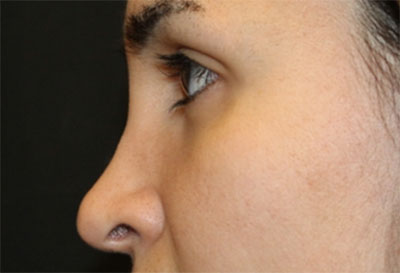 Rhinoplasty Before & After Patient #27163